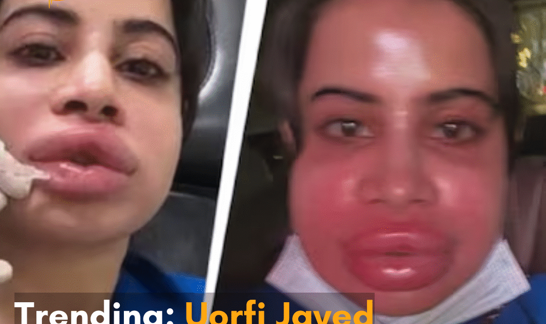 In the now-viral video, Uorfi is seen unrecognizable with a swollen face; netizens react.