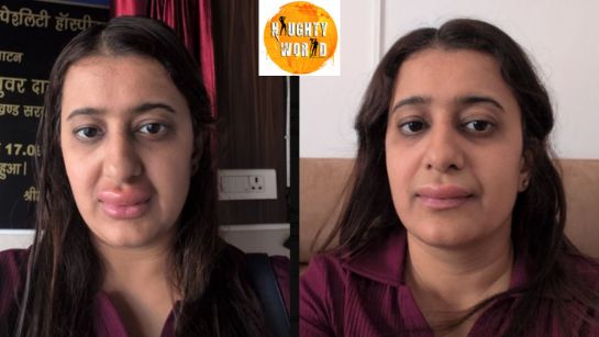 Trending: A Vande Bharat passenger in a post claimed its food gave her an allergy